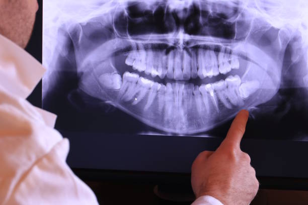 Best Emergency Wisdom Teeth Removal in Colstrip, MT